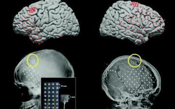 Images of four brains with implants.