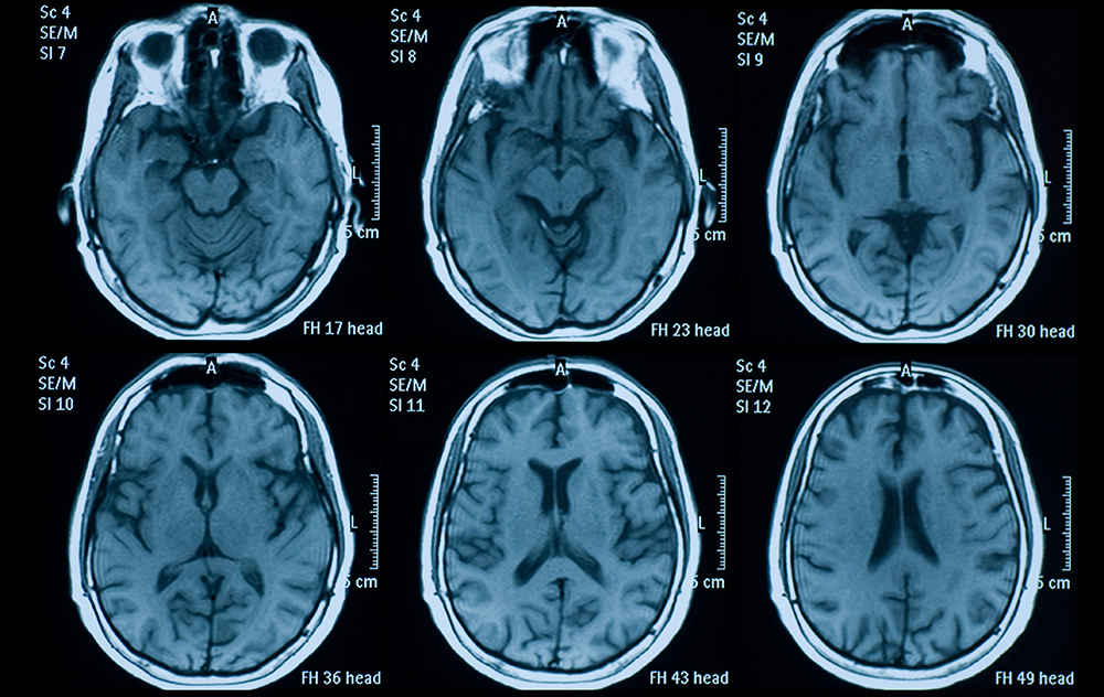 Brain MRI image link to story